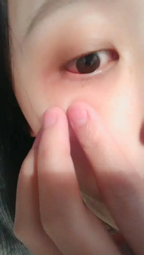 下眼睑上长了个白色的小泡泡 没有异物感 按的话有点痛 这是什么东西
