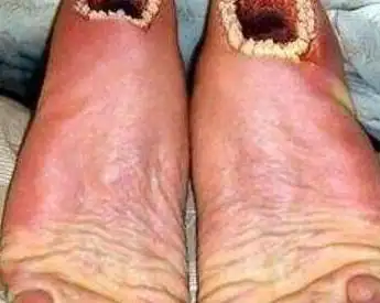 超恶心的手指图片空手指手上全是洞密集症慎入