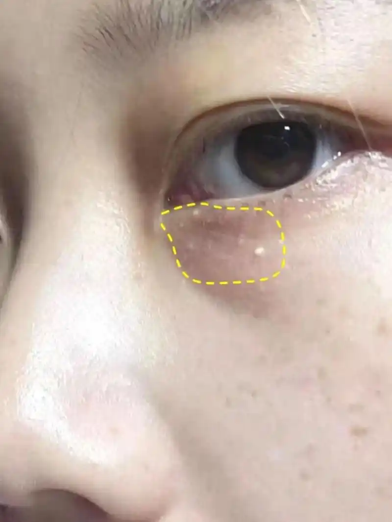 眼周脂肪粒