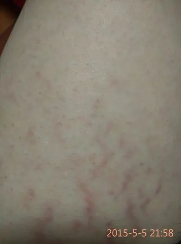 大腿内侧有淤血怎么回事?