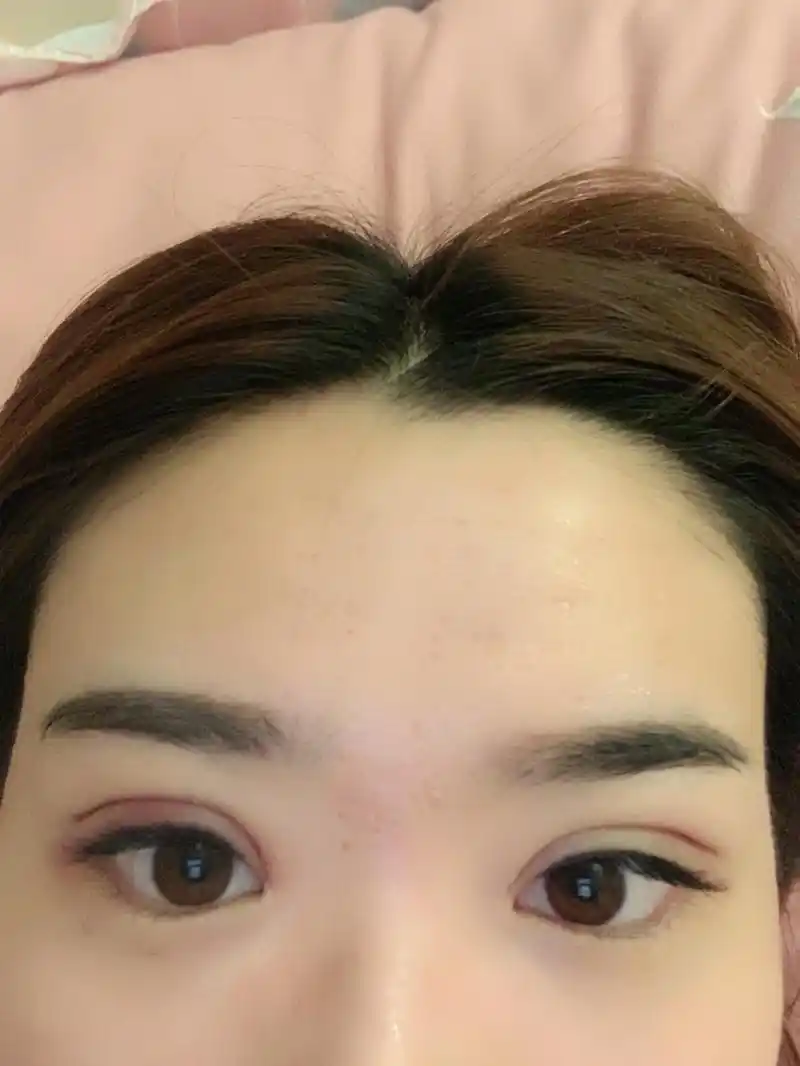 埋线双眼皮第二天