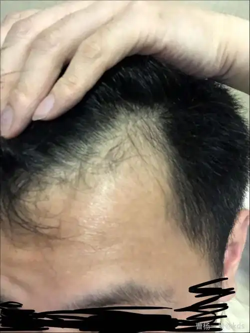 30岁,两额头发已经秃成这样,怎么办?