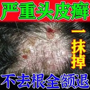 头皮癣专用药膏治牛皮鲜藓银屑毛囊炎根头部痒湿疹有疙瘩专用药膏