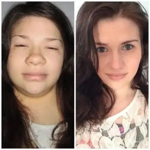 为什么早上脸会变肿,是哪里出了问题?面部浮肿怎么自然消肿?