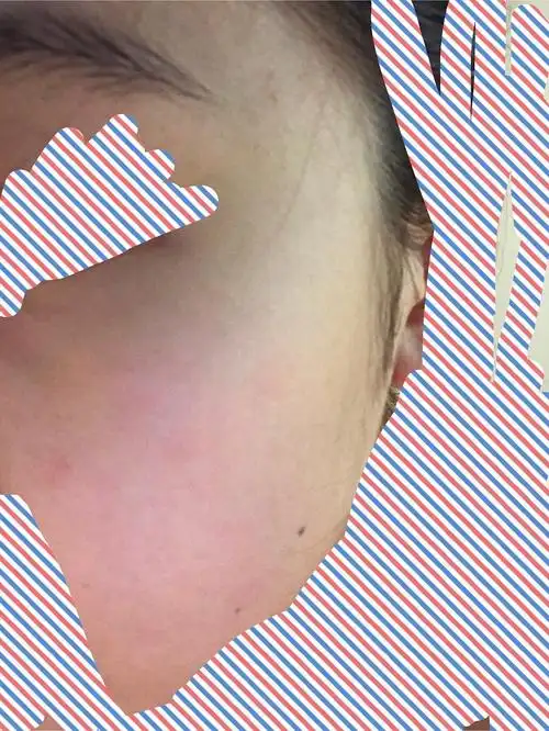 脸过敏了.有图慎入