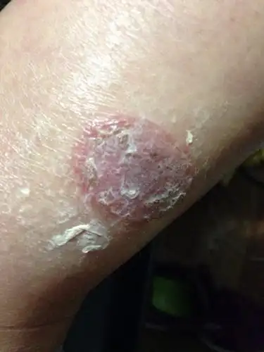 小腿上突然长出烂疮疤,有时候痒有时候不痒的,是什么原因?怎么治疗?