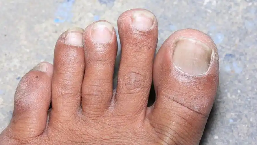 轻微灰指甲图片