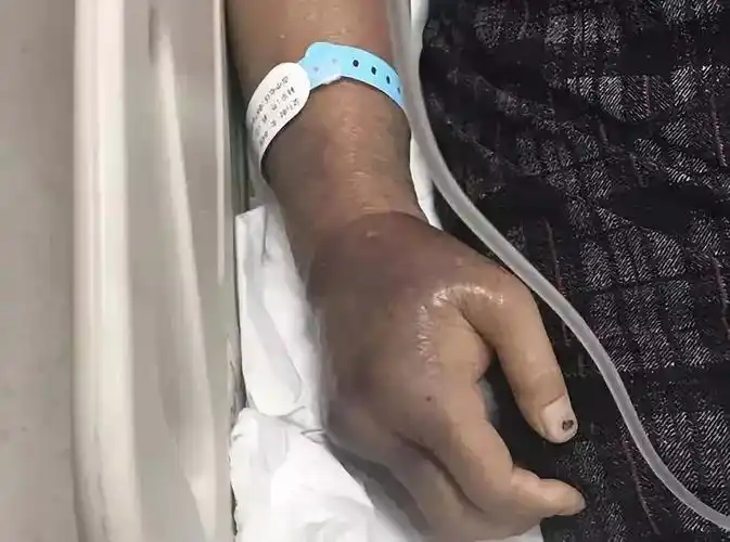 到杭州的时候,黄大姐右手肿胀已至肘部,手臂发黑,有多处破裂流脓的