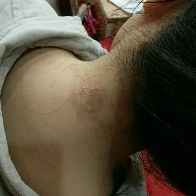 颈部有这麼一块癣,请问有宝妈遇到过吗?这个怎麼办好啊?