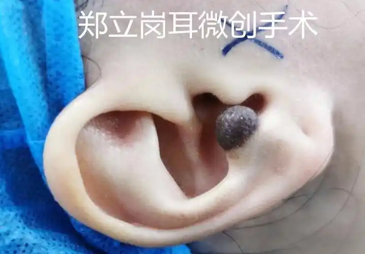 耳廓肿物及时选择手术好处多