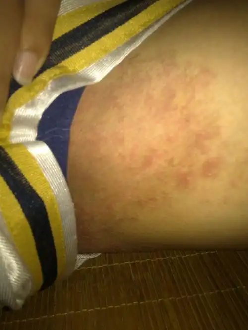 大腿内侧长了些红色的斑块.急!