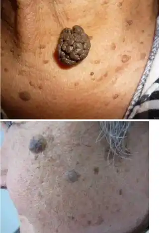 还在为身上的小瘤瘤烦恼吗?冠县中心医院皮肤科帮助您!