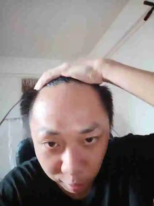 请问超高发际线适合什么发型男