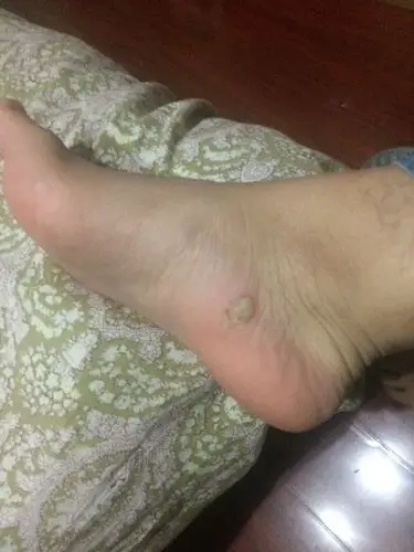 医生 来帮我看看我脚上长的是什么?