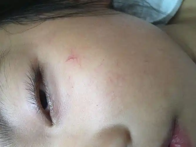 小孩脸上有红血丝怎么回事