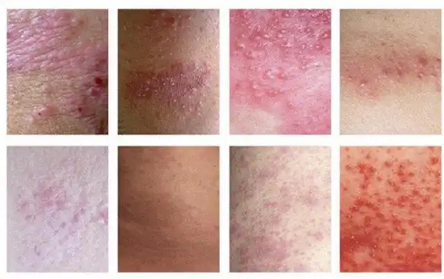 银屑病关节炎症状图片_银屑病求医网