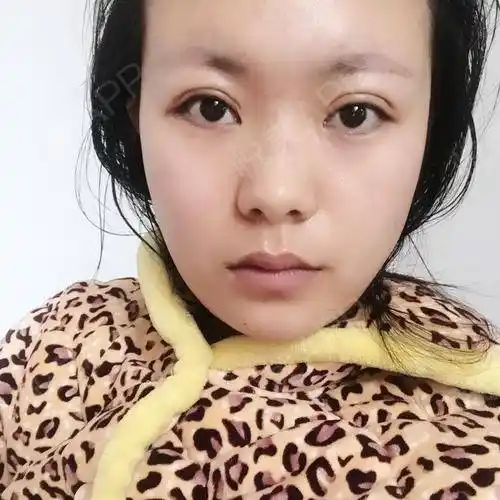 我做的是双眼皮和自体脂肪,眼睛是家庭遗传的单眼皮,.