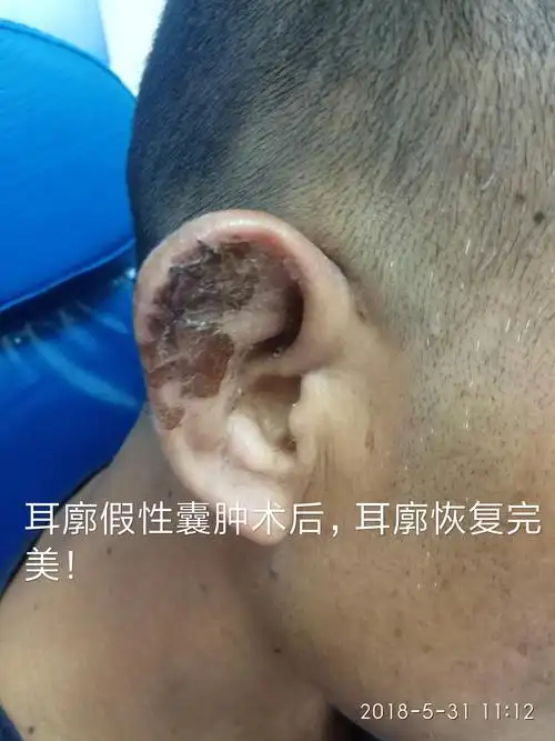 耳朵疾病常见的几种耳内镜照片