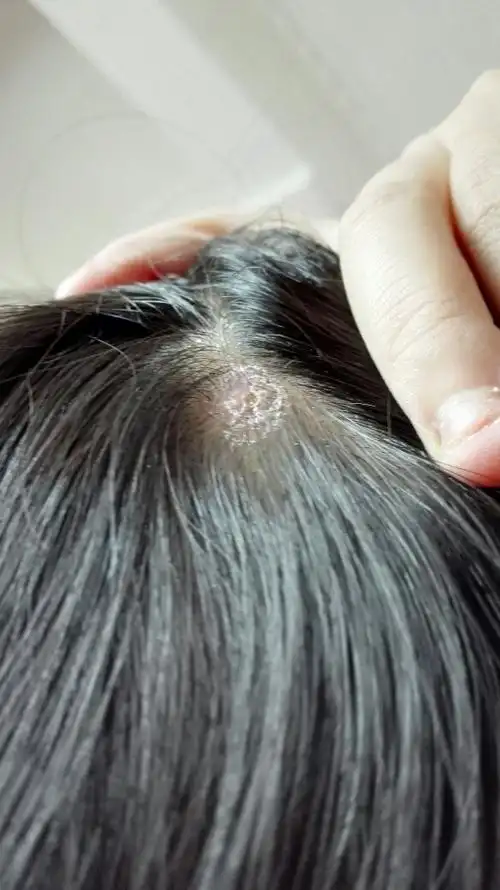 我的头上半个月前长了个包一样的东西,因为不舒服