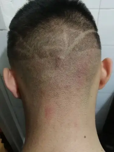 后脑勺一直都有一些红痘痘,用不用抹点药呀