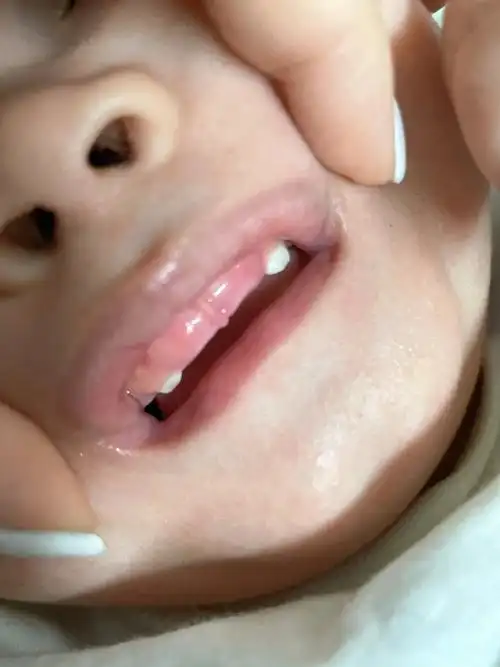 去年八月份的宝宝都长虎牙了没