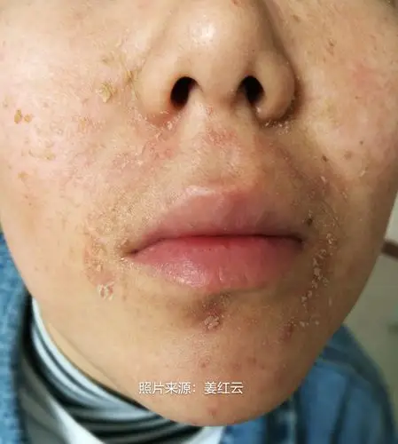 什么抗生素治疗脂溢性皮炎(什么抗生素治疗脂溢性皮炎效果最好)