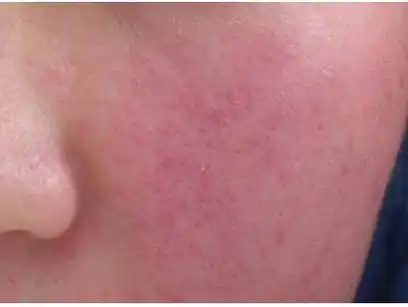 基本上属于敏感体质,你的肤质比较脆弱,抵抗力差,水分"经皮肤