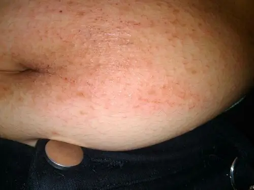 肚子上张了很多这种红点点 很痒!