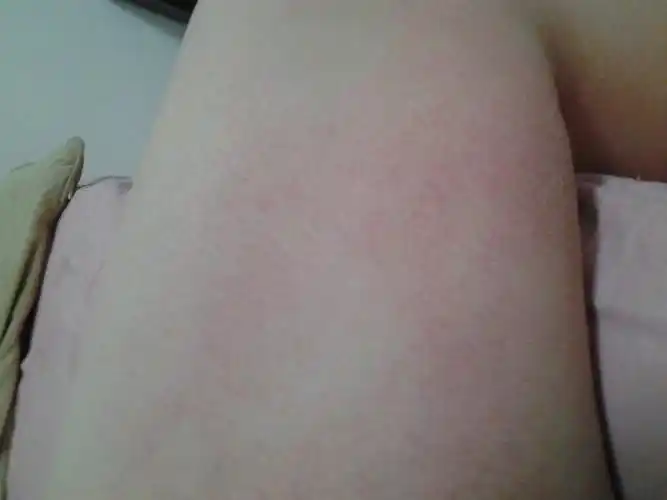 最近两周,在两大腿内侧中间部位,发现有局部发红现象,感觉略痒,可以