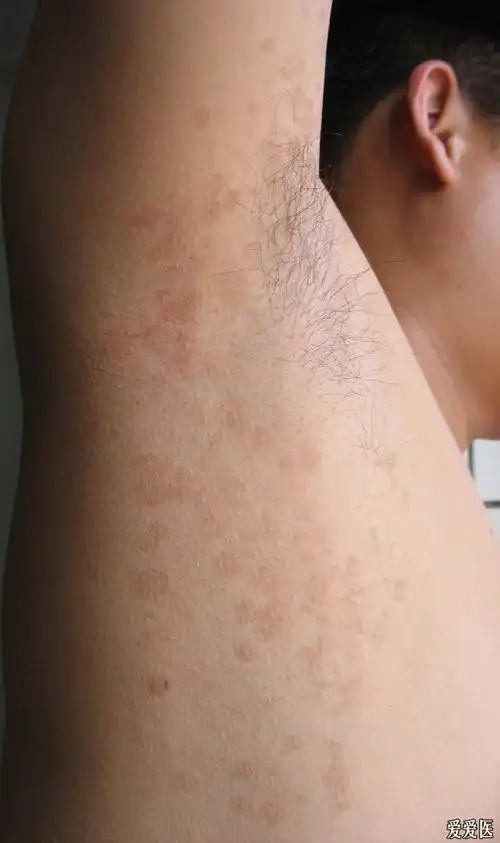 这个皮肤病是花斑癣吗