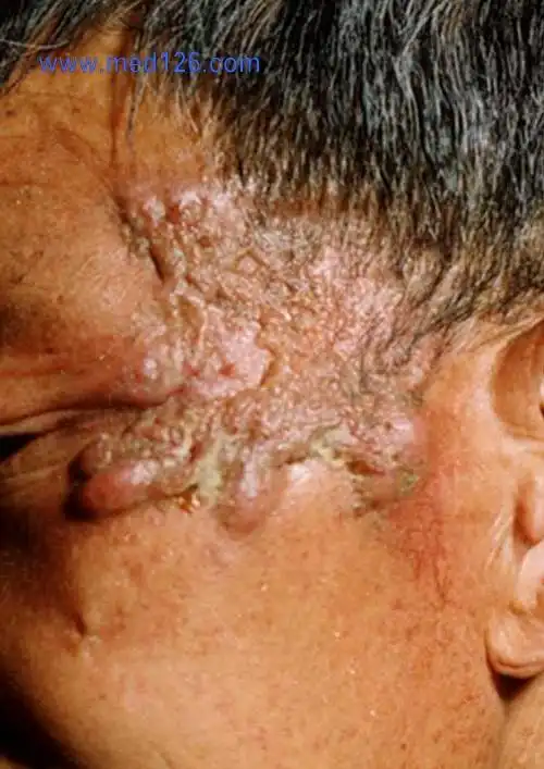 增殖性皮炎(pyoderma vegetans)01,球菌性皮肤病图片