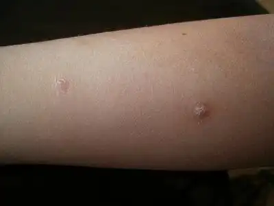 点滴型副银屑病的症状和图片 - 有来医生