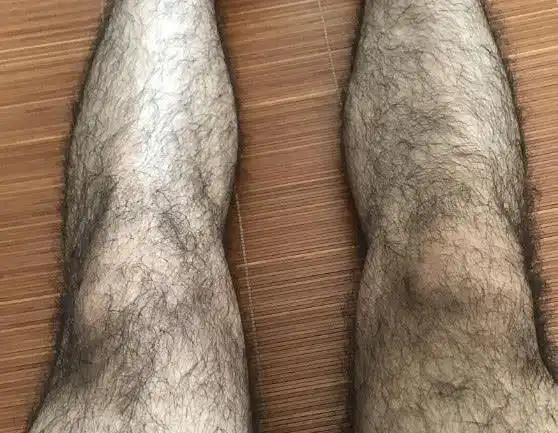 为什么有的男性腿毛浓密而有的却没什么毛来听专家怎么说