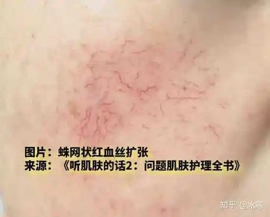 蛛网状红血丝扩张(来源《听肌肤的话2:问题肌肤护理全书》)
