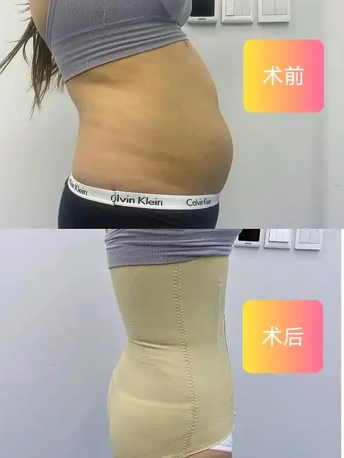 腰腹环吸78终于等来了折角腰60