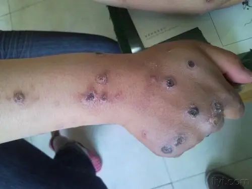 (图片超过100kb,良版已修改,下次注意) - 皮肤及性传播疾病讨论版