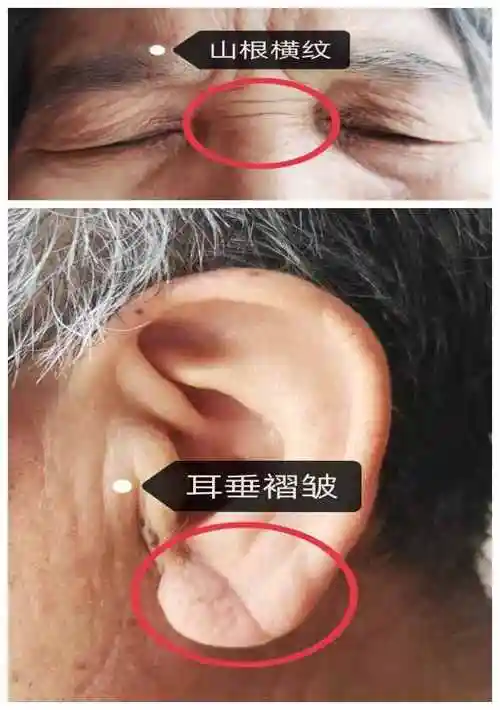 山根是什么山根和鼻梁的区别