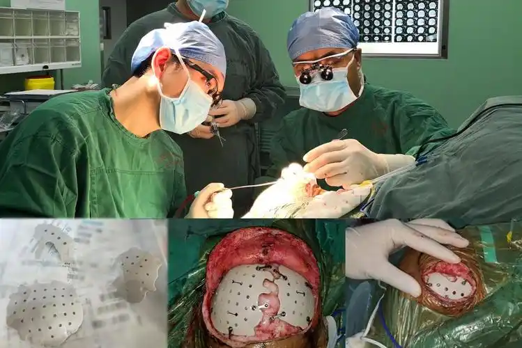 而目前中国医科大学航空总医院创伤脑血管病神经外科的穆苍山主任医师