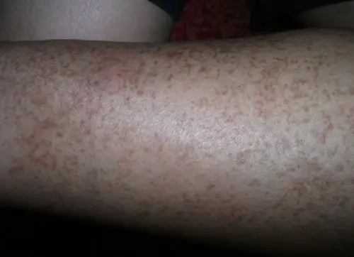 小腿上一直有这样褐色的斑点,很多年了,今天碰到一个中医,说这是糖尿