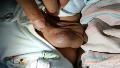 孩子俩月大,今天孩子尿时发现右侧睾丸上肿了个大泡,尿尿时一用力,更