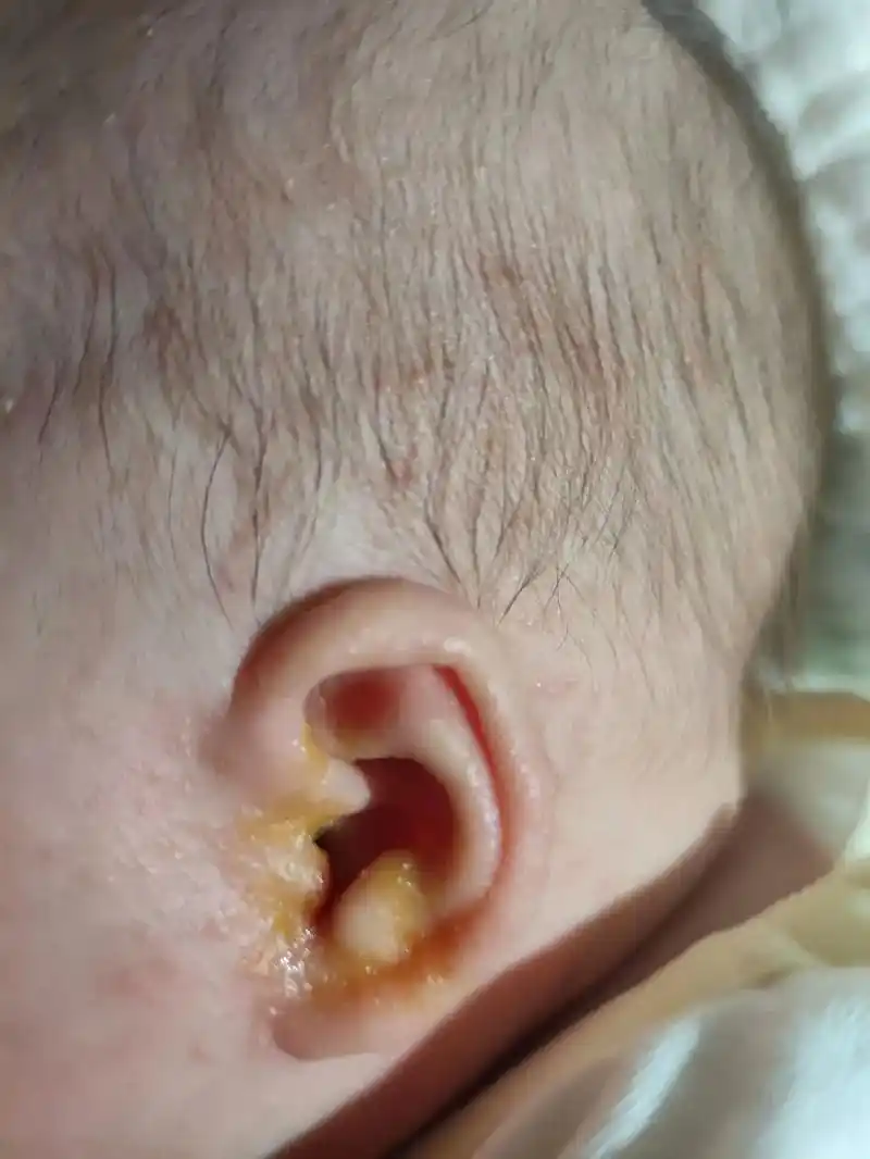 宝宝耳朵因为湿疹流黄水.