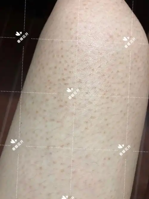 鸡皮肤毛周色素疙瘩去除方法#去鸡皮肤大作战  #去除鸡皮肤色素的小