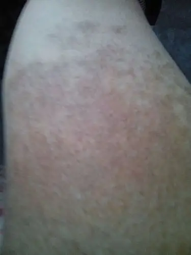 一条大腿局部长毛 皮肤颜色是深黑色 而且毛很多一条大腿局部长毛