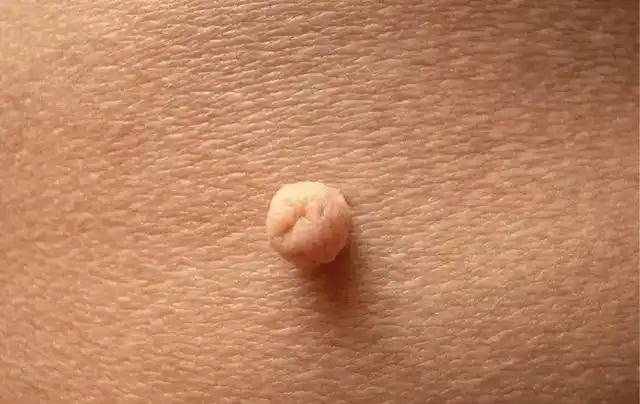 解题思路:这是一个肤色的肉疙瘩,圆形,表面有正常的皮肤纹理,但不粗糙