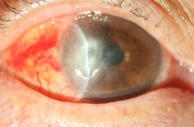 西贡区角膜炎专家_西贡区治疗角膜炎哪个专家好_西贡区治疗角膜炎最好