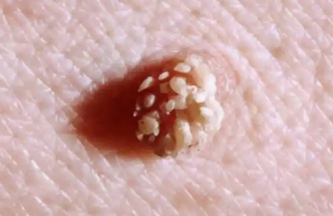 女子脖子上有"肉球",感染hpv,男人3个习惯会"冲垮"子宫|病毒|经期|疣