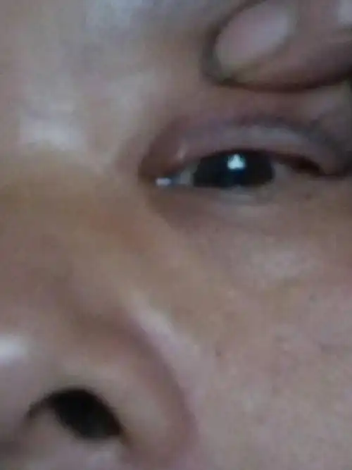 问:眼角里面接近泪腺的地方长了一个疙瘩,好几年了,不疼,有时痒,医生