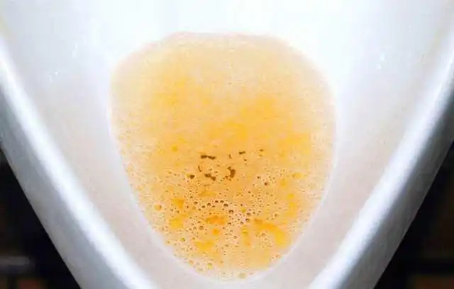 尿蛋白一开始不会超过2 ,痛风患者体内会形成尿酸结晶的,如果肾脏损伤