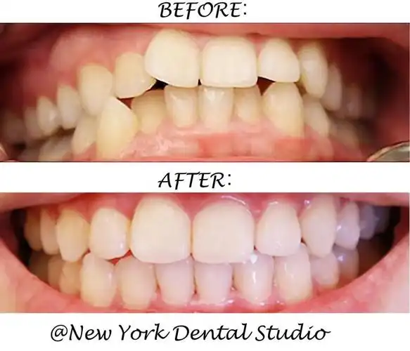 牙齿矫正前后对比实在太大啦!30多岁都不算晚!