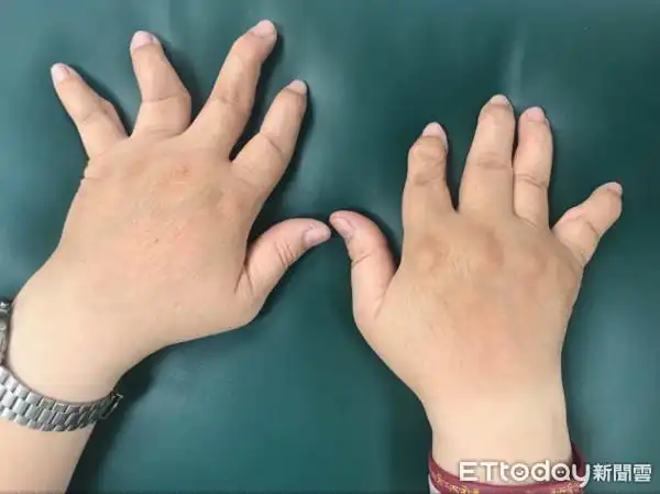这病让她手变形肿成「香肠指」 轻碰就痛,扣扣子也无法!